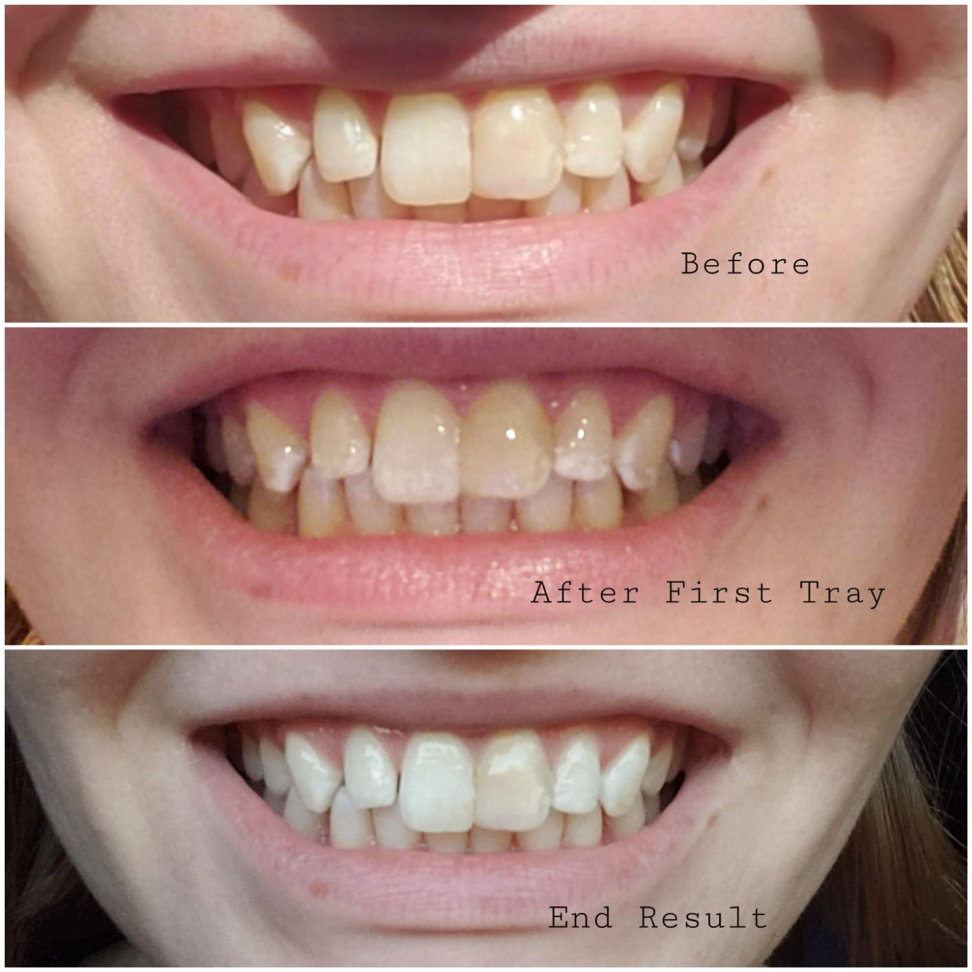 Opalescence Go 15- Prefilled Teeth Whitening Trays - 15% Hydrogen Peroxide - (10 Treatments) customer photo 1