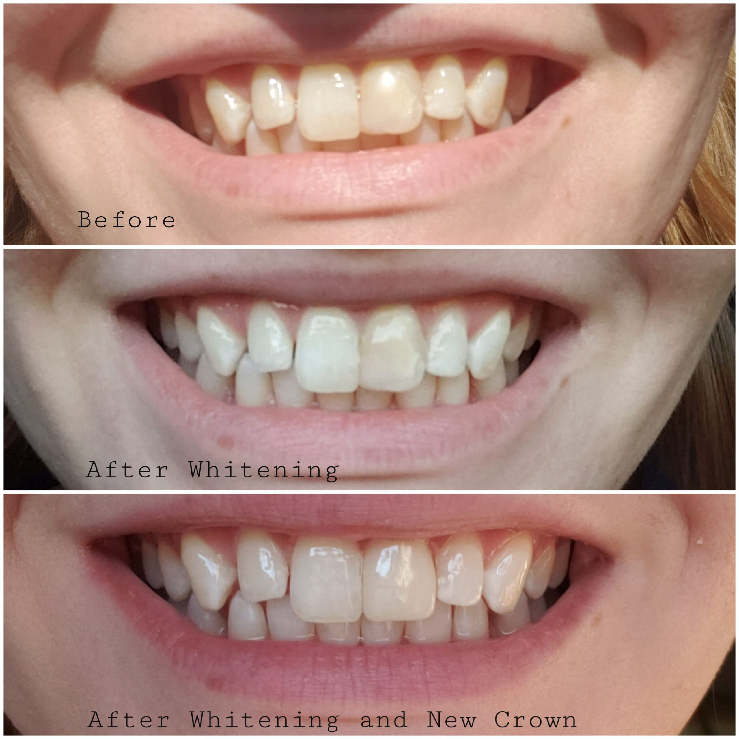 Opalescence Go 15- Prefilled Teeth Whitening Trays - 15% Hydrogen Peroxide - (10 Treatments) customer photo 2