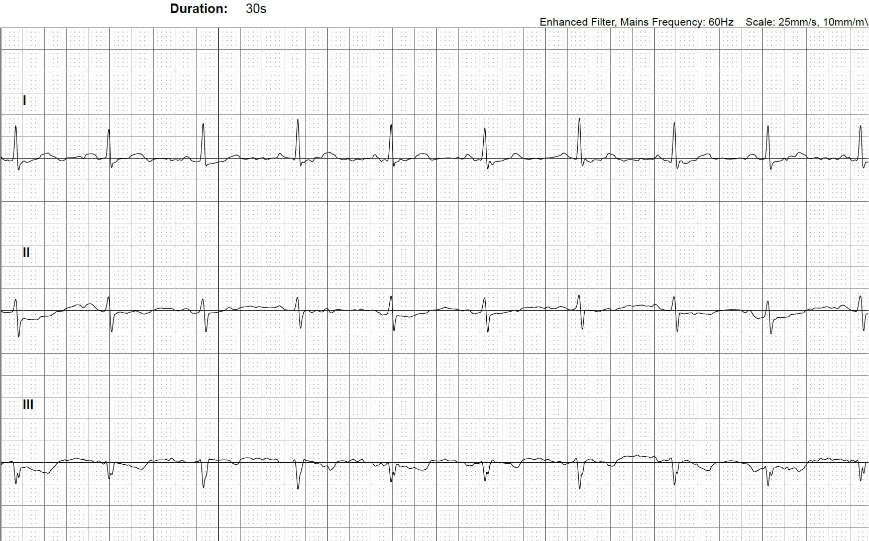 KardiaMobile 6L EKG Monitor, Medical-Grade, FDA-Cleared Heart Monitor, 6 Views of the Heart, Results in 30 Seconds, Unlimited Recordings, Works with Smartphones, HSA&FSA Eligible, Pocket-Size customer photo 1