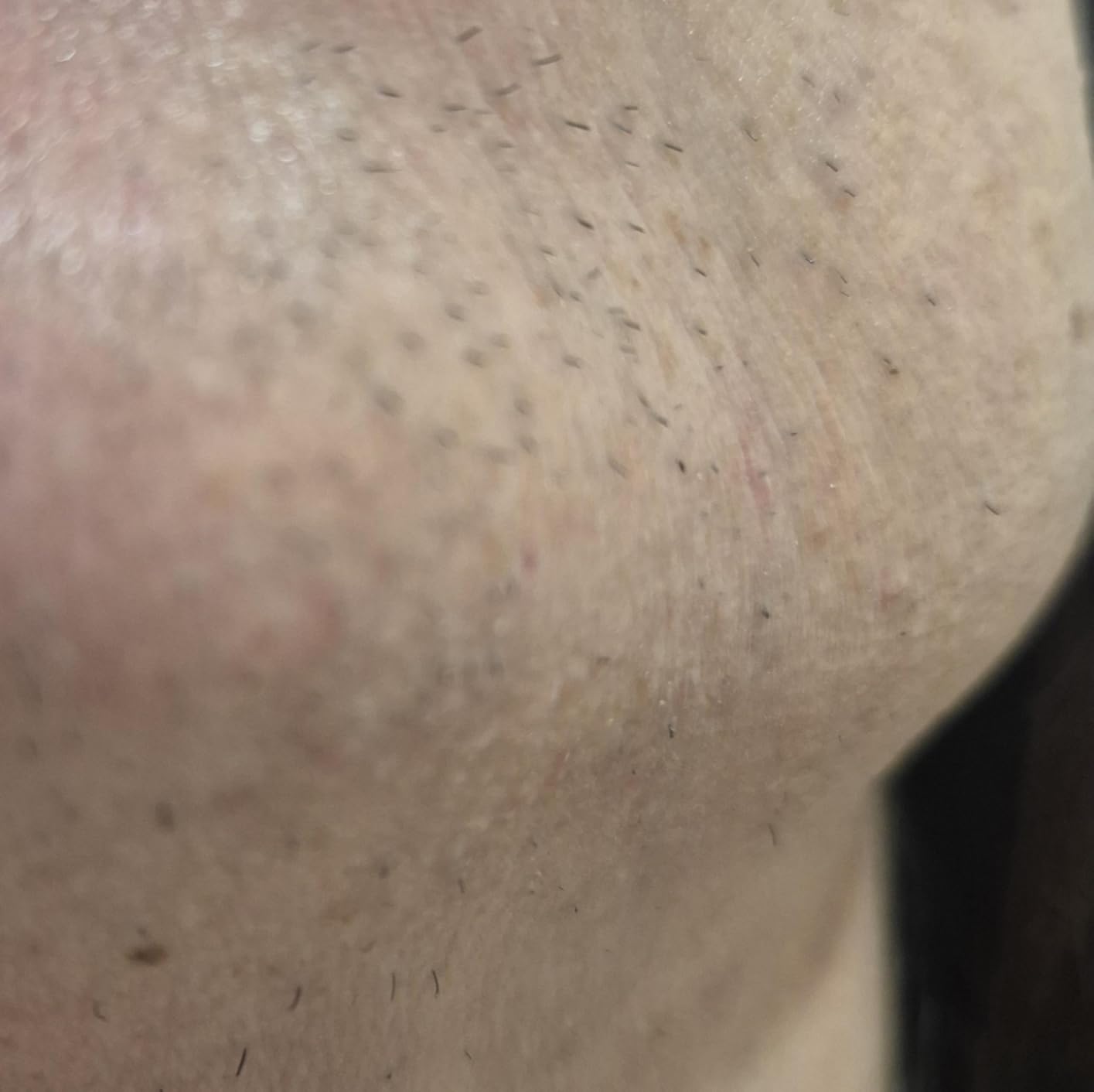 Braun Smart IPL, Skin iExpert Pro 7, VOGUE's Best Hair Removal Device, IPL Hair Removal for Women and Men, Permanent Laser Hair Reduction At-Home, World's 1st Smart App, 4 Heads, IPL7387 customer photo 2