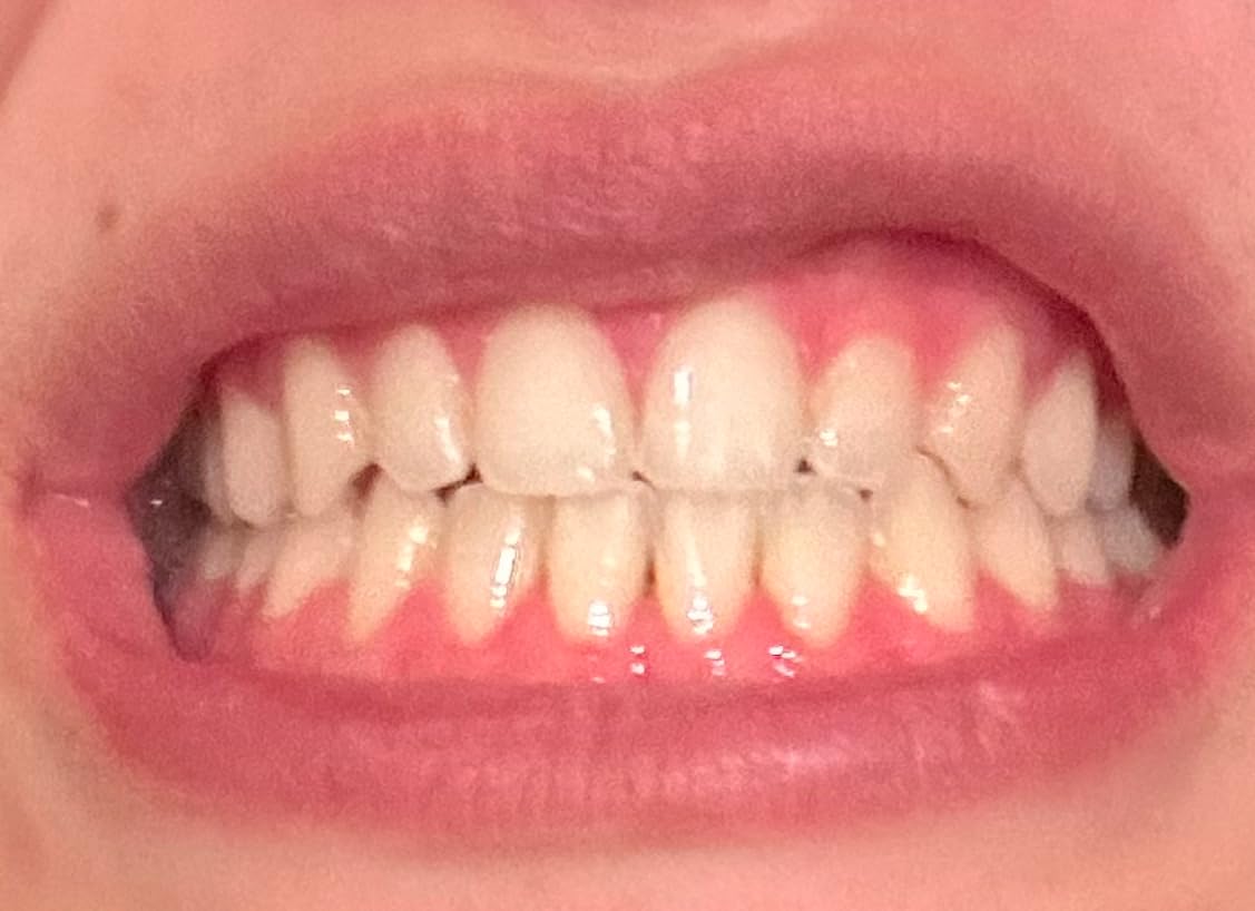 GuruNanda Professional Teeth Whitening Wireless Kit with LED Light & Whitening Pen, 40 Treatments customer photo 1