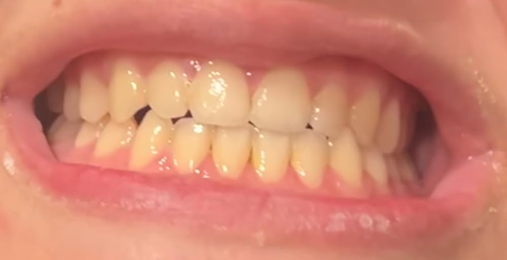 GuruNanda Professional Teeth Whitening Wireless Kit with LED Light & Whitening Pen, 40 Treatments customer photo 2