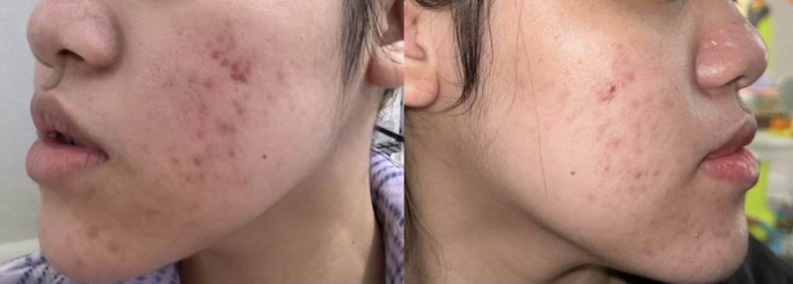 Paula's Choice SKIN PERFECTING 2% BHA Liquid Exfoliant with Salicylic Acid, Facial Polish for Pores, Wrinkles & Fine Lines, Suitable for Blackhead-Prone Skin, Fragrance-Free customer photo 1