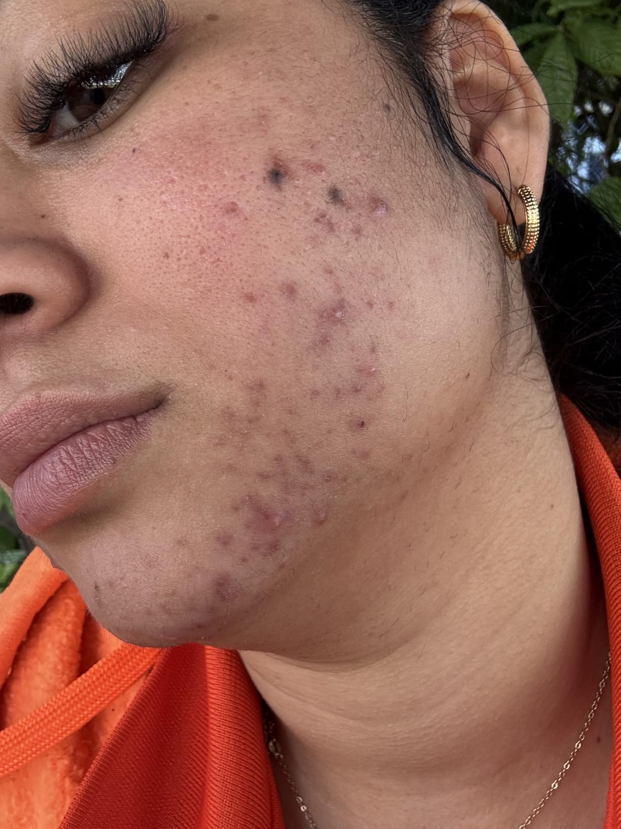 CeraVe Resurfacing Retinol Serum For Post Acne Marks, Formulated With Licorice Root Extract & Niacinamide, Brightening Serum & Pore Minimizer For Face, Post Acne Skin Barrier Repair, Non-Comedogenic customer photo 1