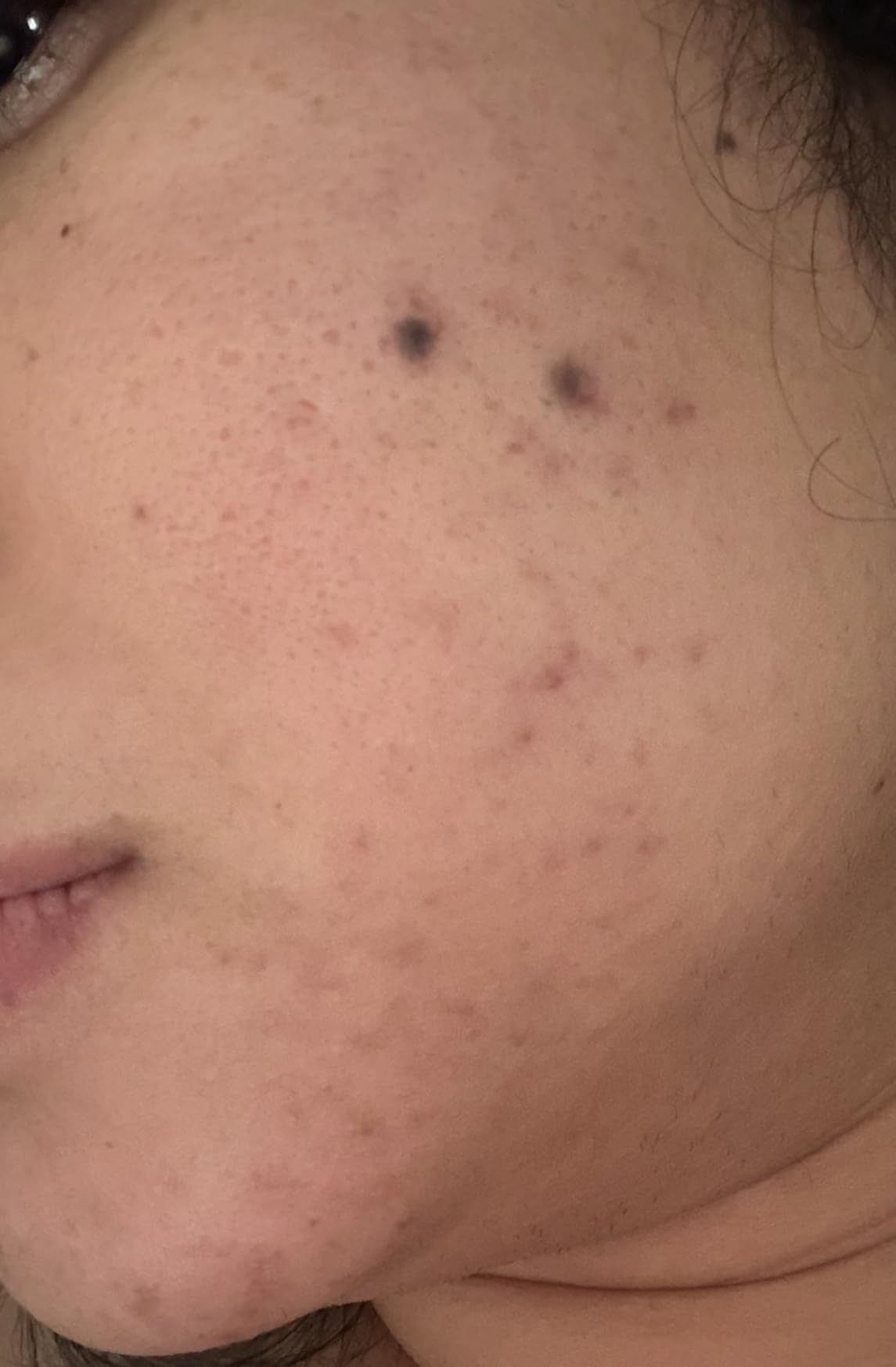 CeraVe Resurfacing Retinol Serum For Post Acne Marks, Formulated With Licorice Root Extract & Niacinamide, Brightening Serum & Pore Minimizer For Face, Post Acne Skin Barrier Repair, Non-Comedogenic customer photo 2