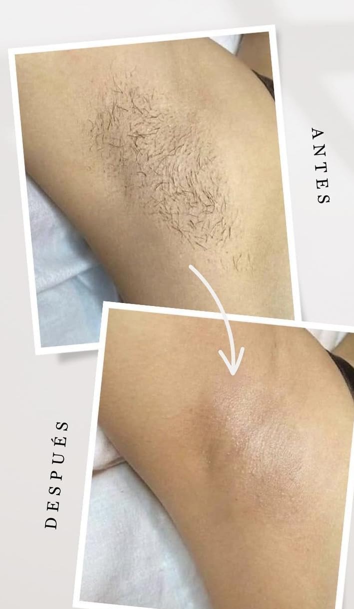 INIA Laser Hair Removal with Ice-Cooling Care for Women and Men, HAUTE Pro Painless at-Home IPL Hair Remover for Coarse Hair in Bikini All Body Areas, Latest Generation for Effective Results (Pink) customer photo 1