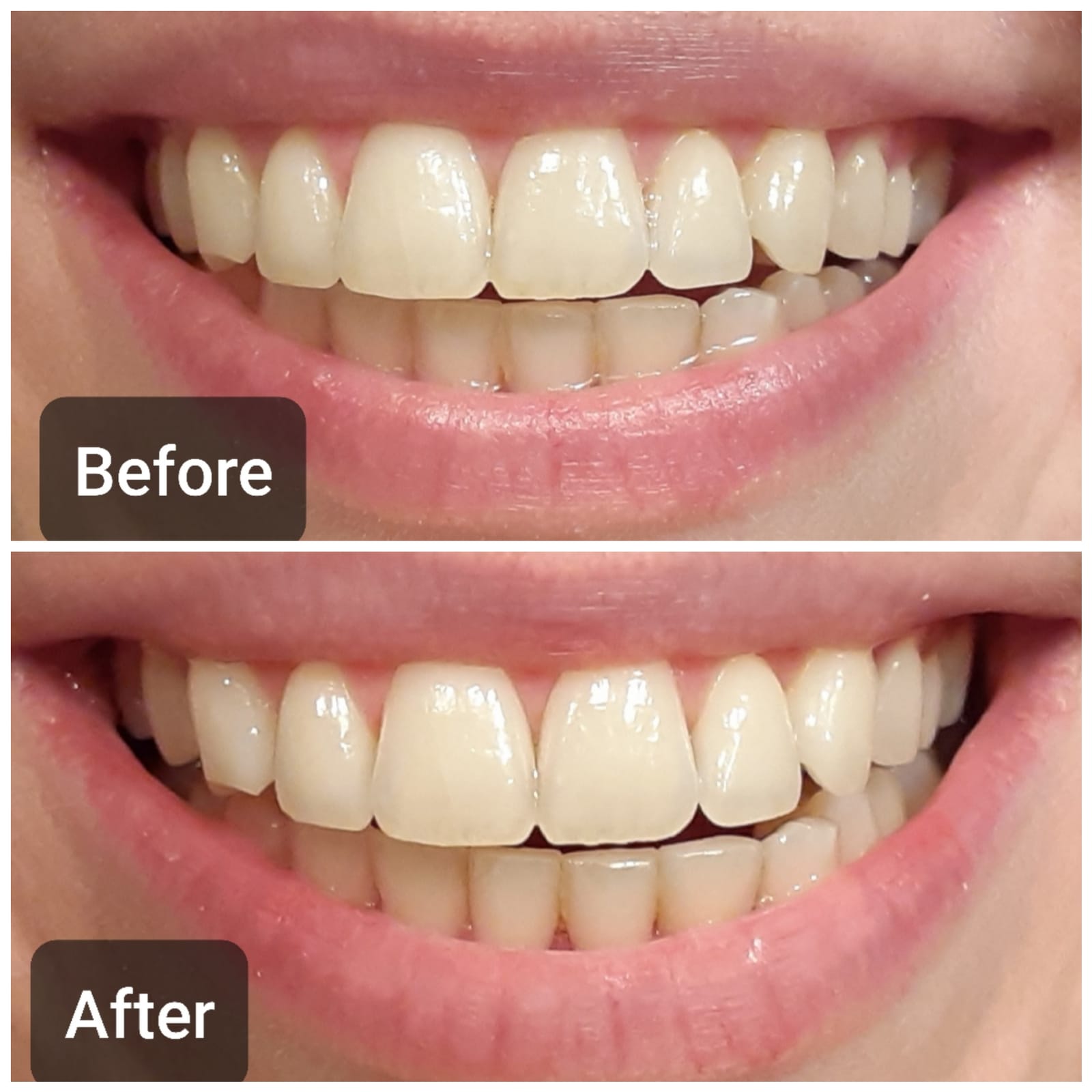 Auraglow Plug-in LED Teeth Whitening Kit - Wired Light Device - 35% Carbamide Peroxide Gel - 12 Treatments - at-Home Tooth Whitening System - Enamel-Safe for Coffee & Tea Stains customer photo 1