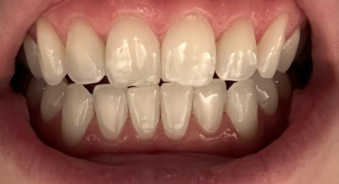 Auraglow Plug-in LED Teeth Whitening Kit - Wired Light Device - 35% Carbamide Peroxide Gel - 12 Treatments - at-Home Tooth Whitening System - Enamel-Safe for Coffee & Tea Stains customer photo 2