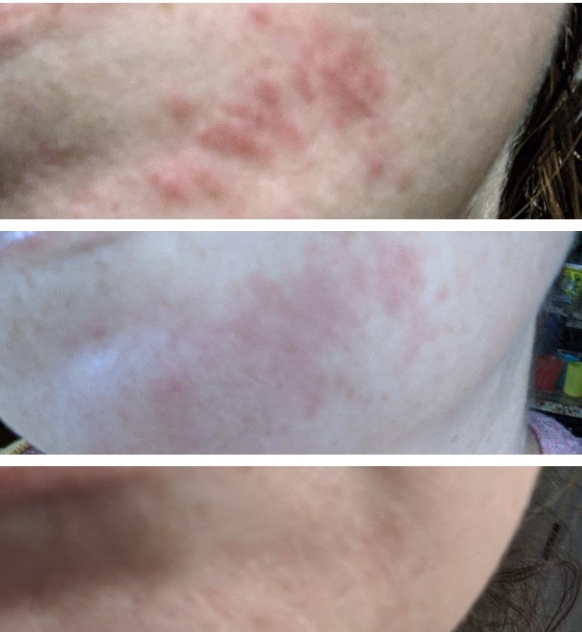 reVive Light Therapy Clinical Acne Device, Red & Blue Light Wand, Full Size customer photo 1
