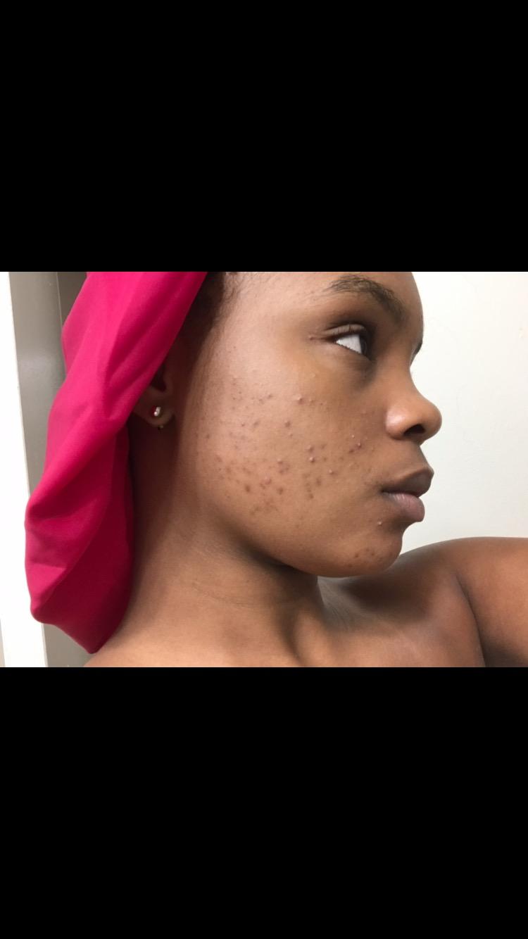 reVive Light Therapy Clinical Acne Device, Red & Blue Light Wand, Full Size customer photo 2