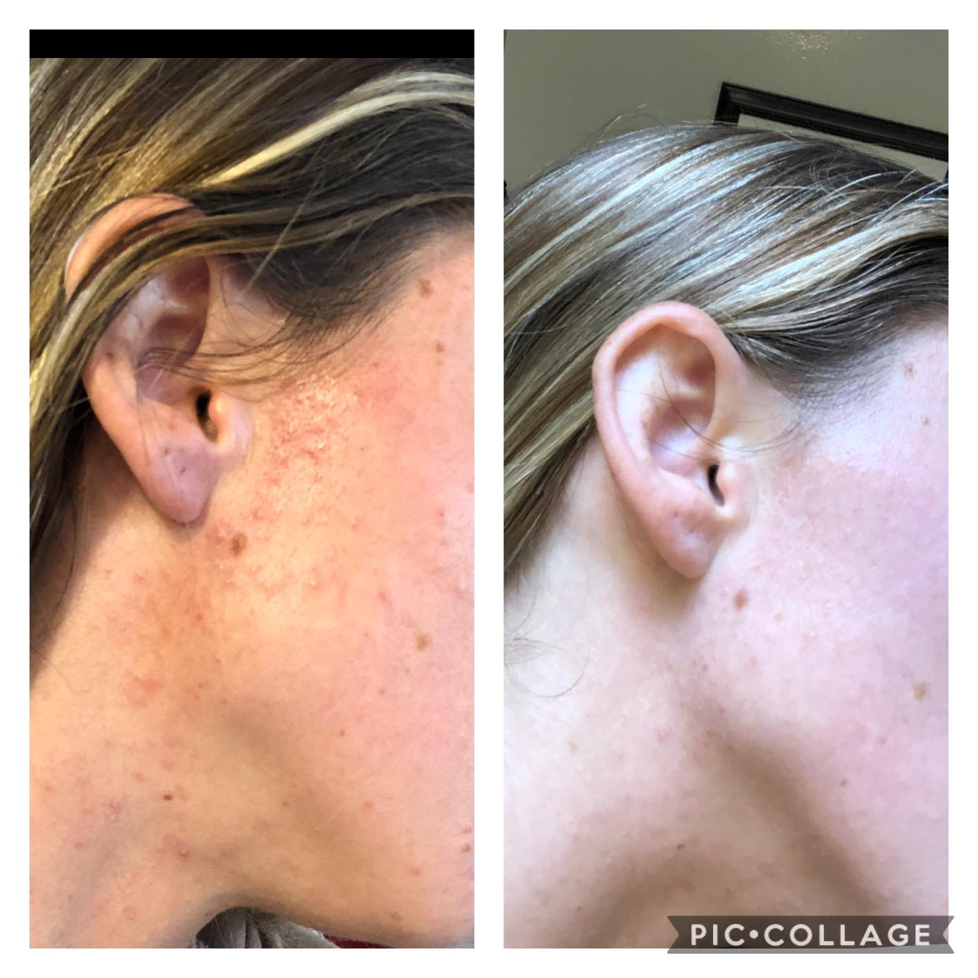 LightStim for Acne LED Red Light Therapy, FDA cleared for mild to moderate acne, reduce acne, calm existing breakouts & restore your skin’s healthy appearance 36 Blue & Red LEDs, 415 & 630 wavelengths customer photo 1