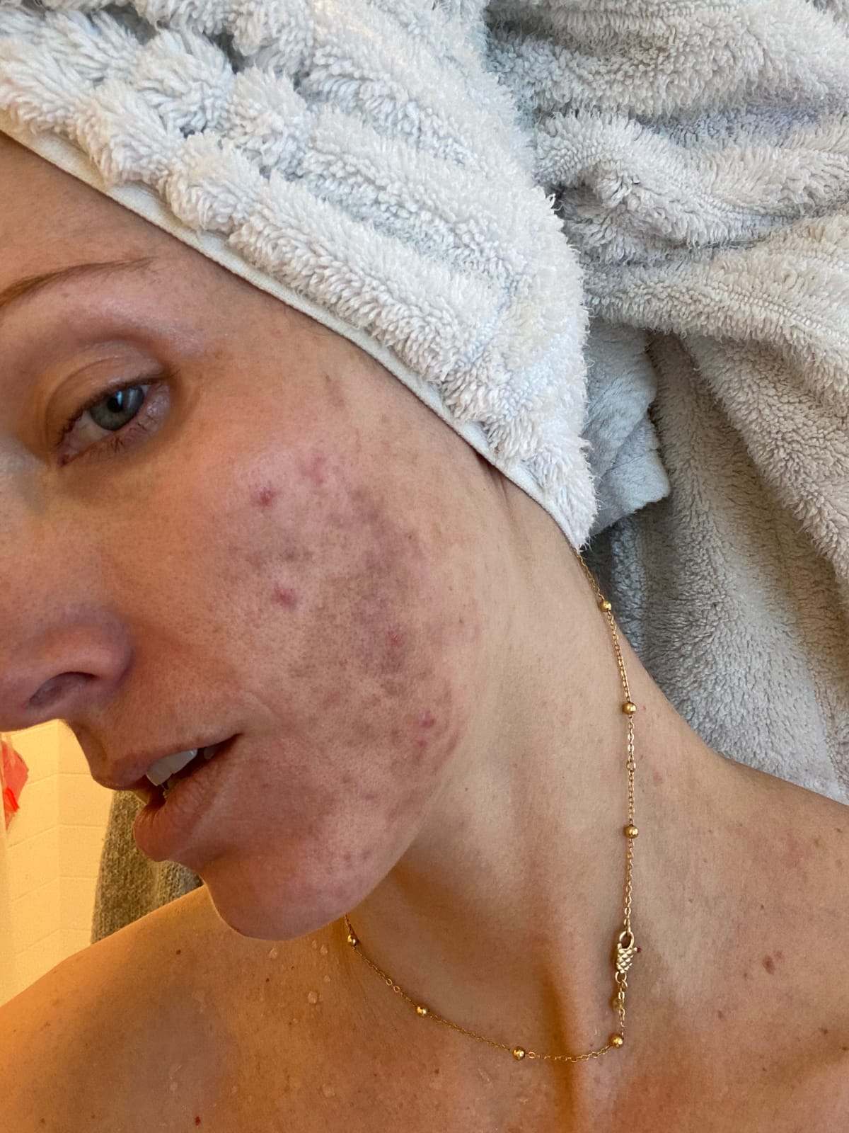 LightStim for Acne LED Red Light Therapy, FDA cleared for mild to moderate acne, reduce acne, calm existing breakouts & restore your skin’s healthy appearance 36 Blue & Red LEDs, 415 & 630 wavelengths customer photo 2